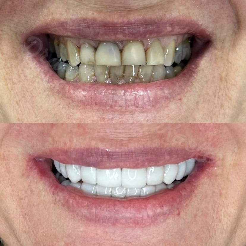 Foto de capa SPAço Oral Dra Thailane Kaefer - Dentista Sinop - Facetas de Resina Composta